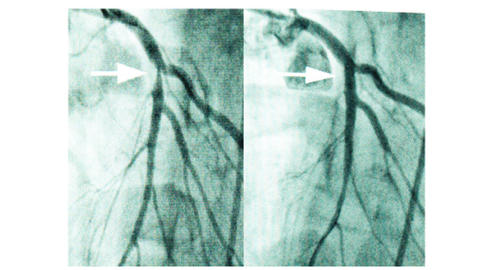 verengte Herzkranzgefäße