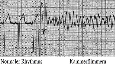 Abbildung-Kammerflimmern