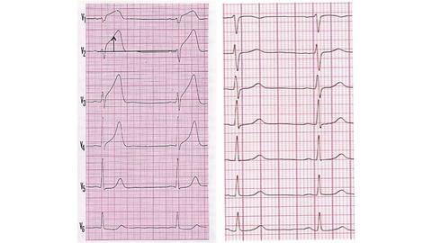 EKG bei Koronardissektion