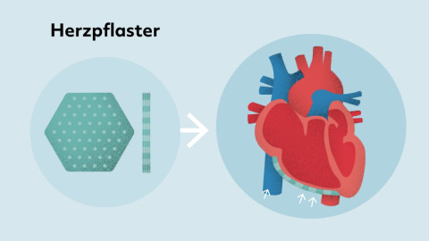 Herzpflaster (Infografik)